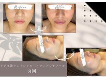 めいてるの雰囲気（ラジオ波フェイシャルでここまで変化！リフトアップ・艶肌・小顔）