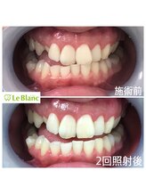 ルブラン 奈良店(Le Blanc)/若い方でも良く見られる黄ばみ