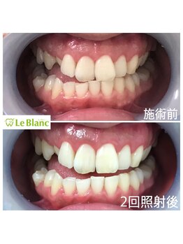 ルブラン 奈良店(Le Blanc)/若い方でも良く見られる黄ばみ