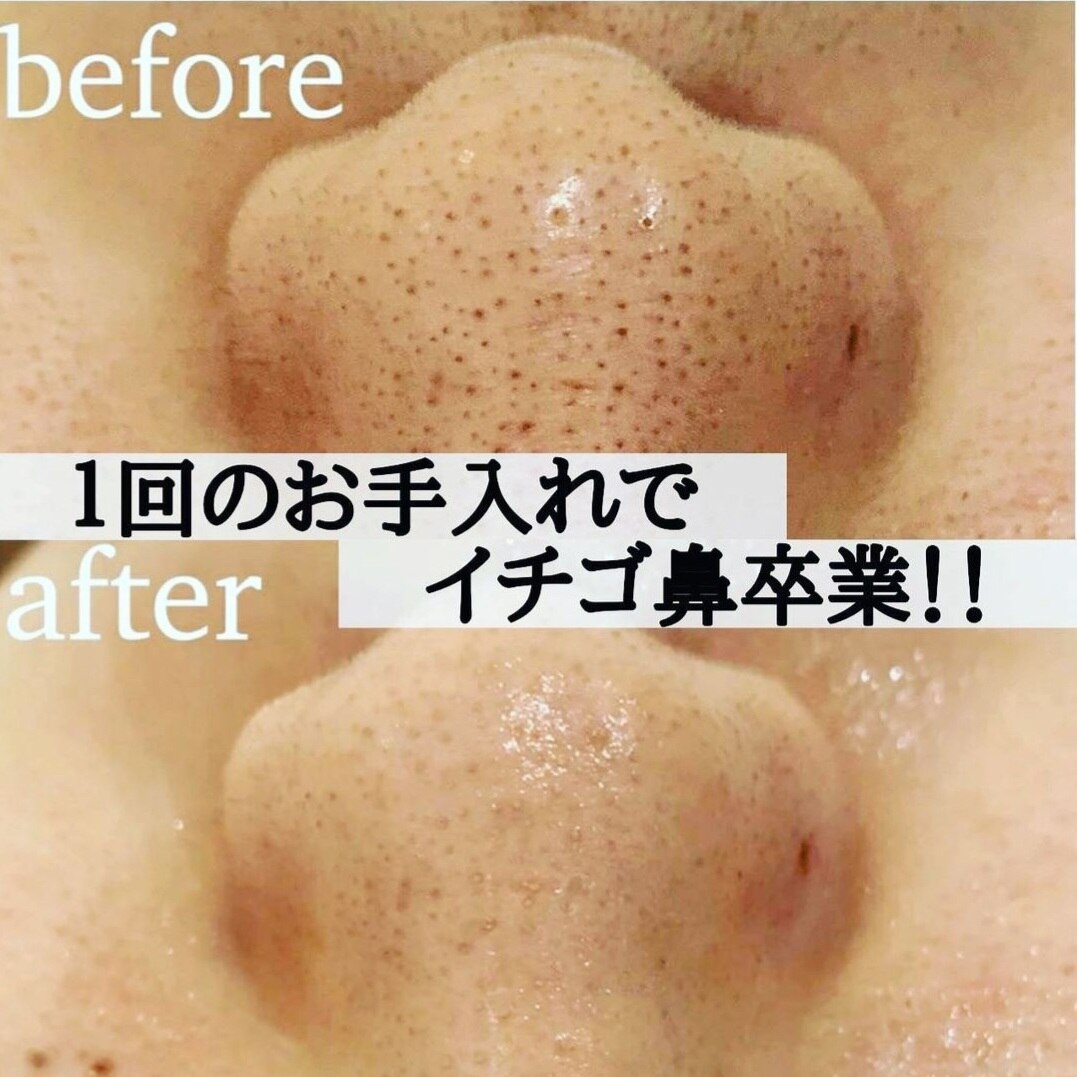 《毛穴悩み》徹底改善9STEP(毛穴洗浄+生コラ導入)90分\4400