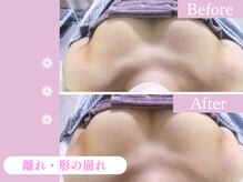 キアナ 横浜店(Kiana)/離れにお悩みの方Before After