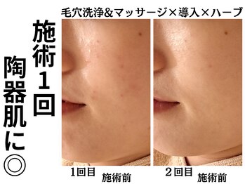 エリン(ERIN)/ハーブピーリング