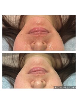 レイモード(Ray mode)/BBLフェイシャル&パック