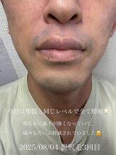 コモレビ(comorebi)/髭脱毛体験談　3回目