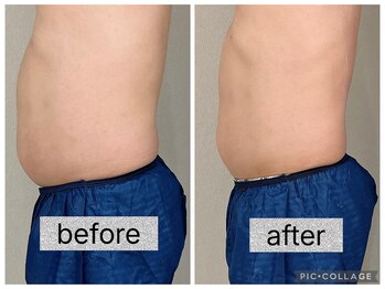 イヨヨ(iyoyo)/【痩身】Before After