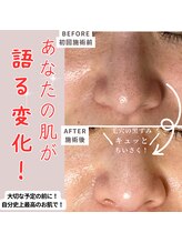 アルエット(Alouette)/ハーブピーリングbefore/after