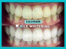 ミルクホワイトニング 新大村店(Milkホワイトニング)/★施術例