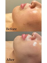 リレイスフクオカ(RelaceFUKUOKA)/ララピール×ソノケア保湿モード