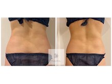 マシェリ 吉祥寺(Macherie)/脂肪燃焼　10ml導入