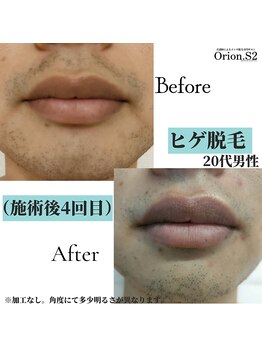 オリオンドットエスツー(Orion.S2)/【Before→After】