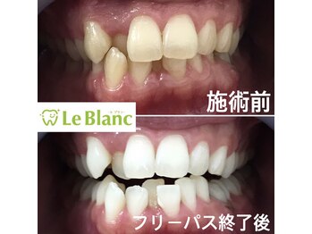 ルブラン 奈良店(Le Blanc)/ムラなく白く！！