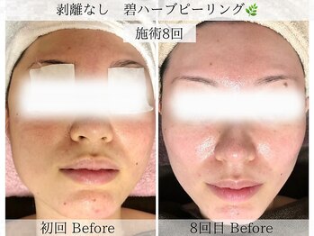 フラリ 西葛西(Hulali)/【30代】ハーブピーリング6回目