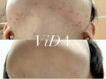 ヴィーダ 渋谷松濤(ViDA)/REVI DT有りハーブピーリング