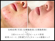 韓国肌管理室 ソア(soa)/【トロイピール】