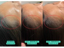 やなけん 亀戸店/生え際が薄くなったお悩み