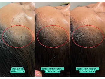 やなけん 亀戸店/生え際が薄くなったお悩み