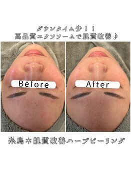 エヌプラス(N+)/30代女性＊ピーリング3回後(1)