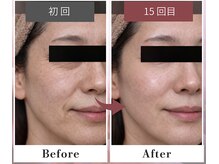 フルリール/【メソポレーションケア】