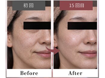 フルリール/【メソポレーションケア】