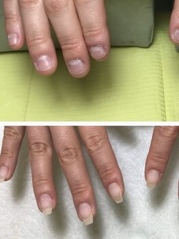 キャッツアイ(cat's eye)/深爪育成☆ジェルネイルで美爪へ