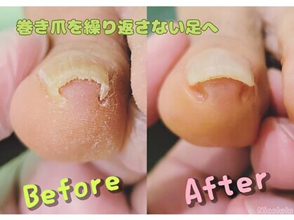 魚の目と巻き爪の専門店　フットケアサロン Nicolulu 大阪天満店【ニコルル】の写真