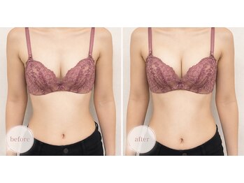 ミモア ローズ(Mimore Roze)の写真/<気になるお肉を徹底アプローチ>ドレスも綺麗に着こなせるスッキリとしたバスト・ラインへ♪