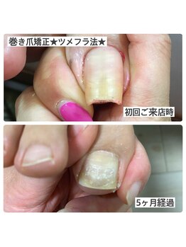 マニュコクーン(ManuCocoon)/爪育成 深爪 巻き爪 大阪市