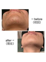 リモアボーテ(RIMOA beaute)/ヒゲ脱毛