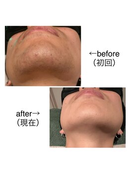 リモアボーテ(RIMOA beaute)/ヒゲ脱毛