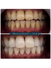 ホワイトニングショップ 鳳店/BeforeAfter 美白ホワイトニング