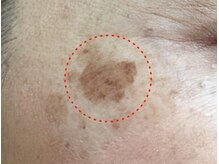 ラヴィアンローズ(La vie en Rose)/シミケアコース