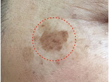 ラヴィアンローズ(La vie en Rose)/シミケアコース