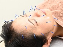 あおい鍼灸接骨院