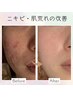 【新生活応援・女性限定クーポン】毛穴・ニキビ改善モニター様価格/30分×3回