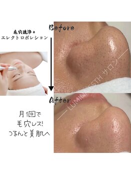 ルミナエステ(LUMINA ESTH)/毛穴/毛穴洗浄/毛穴ケア|症例