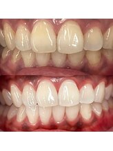 シエル(CIEL)/医療提携セルフホワイトニング