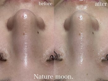 ナチュールムーン(Nature moon.)/毛穴洗浄