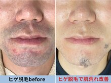 ミスターアンクール 鹿児島(Mr.uncoeur)/ヒゲ脱毛による肌荒れ改善