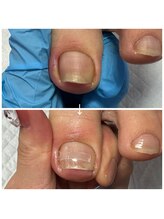 ネイルサロンアンドスクール ペルシャ(Persia)/巻き爪ケア