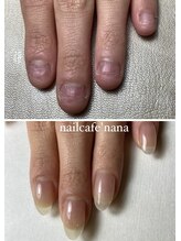 ネイルカフェ ナナ(nailcafe'nana)/自爪育成矯正