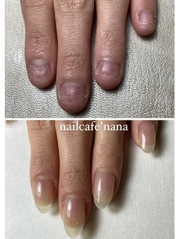 ネイルカフェ ナナ(nailcafe'nana)/自爪育成矯正