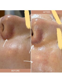 ラヴィン/毛穴の汚れゴッソリ!