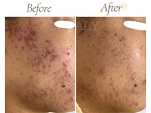 ミラリー(MIRALY)/肌荒れ跡ケア途中経過 6ヶ月