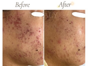 ミラリー(MIRALY)/肌荒れ跡ケア途中経過 6ヶ月