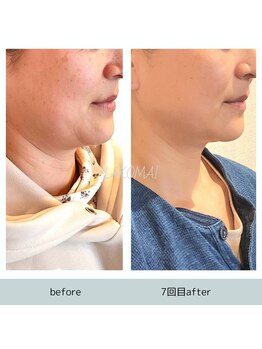 ラコマイ(LAKOMAI)/小顔フェイシャルでたるみケア!