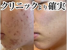 アンドピエル(AndPiel)/見られても良い肌に！！