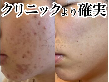 アンドピエル(AndPiel)/見られても良い肌に！！