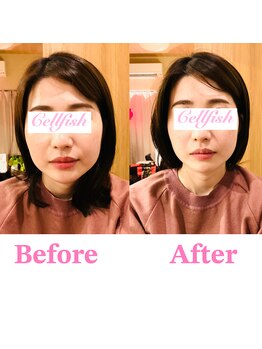 セルフィッシュ(Cellfish)/たった一度で小顔へ変身