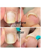 カラーホリック ネイルスパ(Colorholic Nailspa)/巻き爪補正