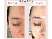 レクラ バイ ドクターエイチ(L'ECLAT by Doctor.H)/無針水光注入”美容液真皮導入”